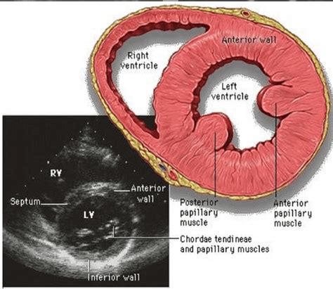 lv parasternal short axis systole and diastole|Abnormalities on the Parasternal Short Axis View.